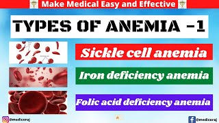 Types of anemia1sickle cell anemiaIron deficiency anemiaFolic acid deficiency anemiacauses [upl. by Lally901]