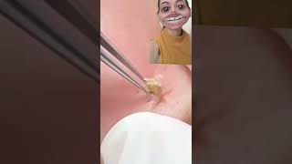 Blackheads Removal  Acne Treatment and Very Satisfying Satisfying Pimple pop blackheads [upl. by Etnwahs]