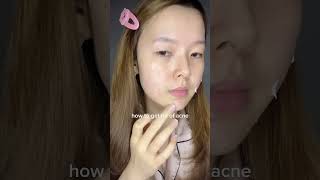 if you have acne you need to try this viral japanese ✨Lion Pair Acne Treatment✨ skincare acne [upl. by Llamaj]