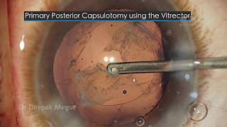 Primary Posterior Capsulotomy by using a vitrector The Secrets Dr Deepak Megur [upl. by Jaban918]