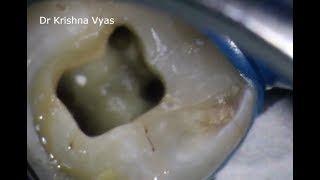 Access Cavity preparation part 1 [upl. by Enilekcaj]