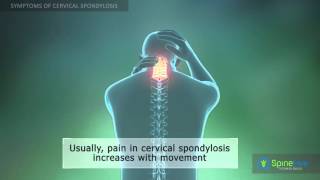 Cervical Spondylosis Symptoms [upl. by Anelrats899]