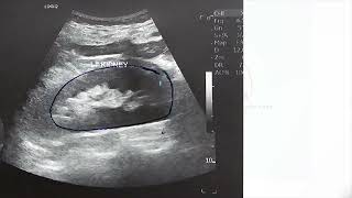 KIDNEY BIOPSY  CONTRAINDICATIONS  VIDEO 171 MD TOPICS [upl. by Adlitam]