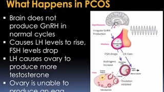 Understanding Polycystic Ovary Syndrome Video – Brigham and Women’s Hospital [upl. by Leibarg995]