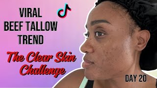 I Tried The Beef Tallow Clear Skin Challenge  Day 20 [upl. by Jasik]