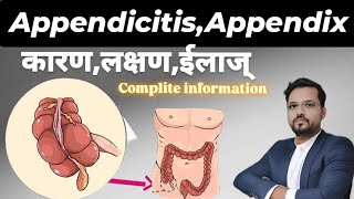 What is APPENDICITIS  Appendix kya hai  APPENDICITIS causes symptoms treatment [upl. by Blanche215]