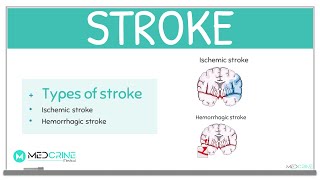 Stroke Definition Classification Causes Symptoms Diagnosis and Treatment [upl. by Adel698]