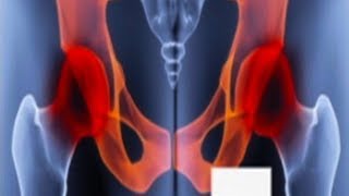 Chronic Pelvic Pain  Usapang Pangkalusuga [upl. by Annawek]