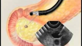 Endoscopic Ultrasound with Fine Needle Aspiration Biopsymp4 [upl. by Lemuel]