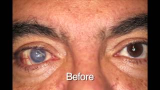 Custom Color Contacts  Prosthetic Before and Afters [upl. by Anyrtak55]