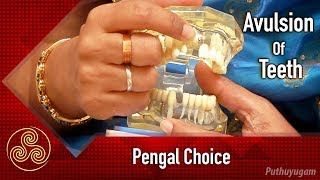 Avulsed Tooth Treatment amp Management  Pengal Choice [upl. by Adnirem]