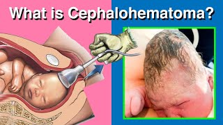 All you need to know about Cephalohematoma [upl. by Nonnac]