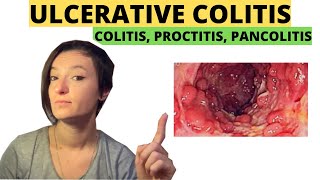 Ulcerative Colitis Proctitis Pancolitis How to heal naturally [upl. by Kobe970]