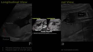 Posterior amp Fundal Placental Position On Ultrasound  Pregnancy USG posteriorplacenta placenta [upl. by Prior348]