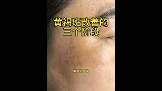 Laser chloasma treatment process [upl. by Prudence552]