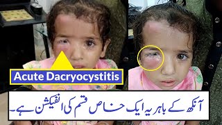 Case Study Of Acute Dacryocystitis  Urdu Hindi [upl. by Aivon]