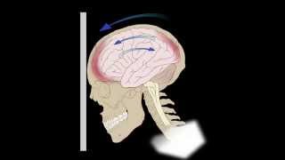 Common Brain Injuries Coupcontracoup [upl. by Odlamur]