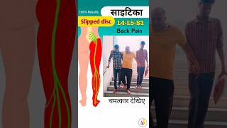 😱साइटिका का दर्द  Nerve Root Compression✅🔥🔥 sciatica [upl. by Sesmar246]