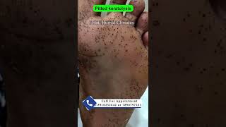 Pitted keratolysis  By Dr Uttam Kumar Lenka MBBS MD Consultant Dermatologist [upl. by Cosmo741]