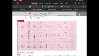 Cardiac axis deviation 🖤 [upl. by Fidelis]