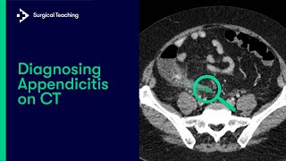 Diagnosing Appendicitis on CT [upl. by Nosde]