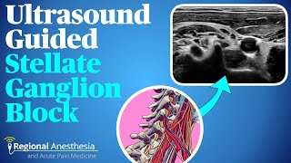 Ultrasound guided stellate ganglion block [upl. by Aika]