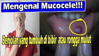 MENGENAL MUCOCELE BENJOLAN YANG TUMBUH DI BIBIR ATAU RONGGA MULUT [upl. by Shawna]