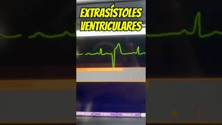 Mis extrasístoles ventriculares son de riesgo⁉️🤔⚠️ emergency cardiology [upl. by Onitnerolf]