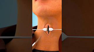 Tracheostomy Surgery Tracheostomy procedure 3D animationTracheostomy Tubeviralshortsdrsadiayt [upl. by Yemerej]