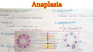 Anaplasia  Neoplasia  General Pathology [upl. by Astrahan]