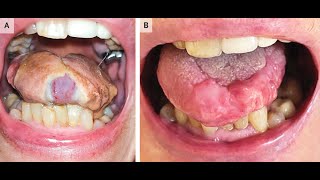 Nekrose der Zunge bei Riesenzellarteriitis [upl. by Neelloj]