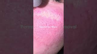 How to remove scars PERMANENTLY skincare beauty skincaretips [upl. by Nehgam]