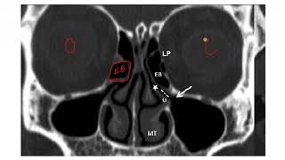 OMC OSTEOMEATAL UNIT PNS MAXILLARY SINUS RADIOLOGY CT ANATOMY [upl. by Odla]