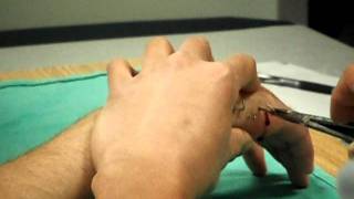 6 pinskwires removed from healed hand [upl. by Nally348]