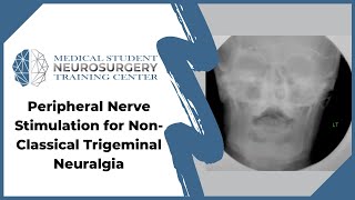 Peripheral Nerve Stimulation for NonClassical Trigeminal Neuralgia [upl. by Yrekaz]