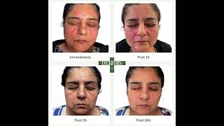 Part 3 Face amp Eyes Rejuvenation at Dermis Clinic [upl. by Eiwoh]