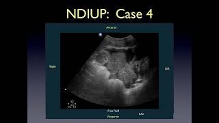 Transvaginal Pelvic Ultrasound [upl. by Nosam]