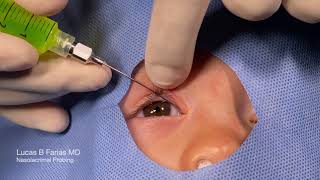 Probing of Nasolacrimal Duct with Fluorescein Irrigation [upl. by Pelag]