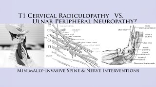 How to Differentiate T1 Cervical Radiculopathy vs Ulnar Nerve Neuropathy Cubital Tunnel Syndrome [upl. by Idur539]