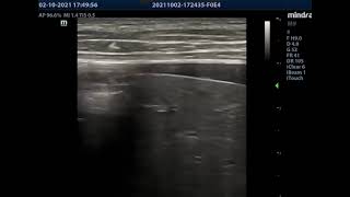 Pneumoperitoneum Ultrasound [upl. by Kronick872]