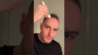 Derma stamp tutorial hair hairgrowth hairtransformation dermastamp microneedling dermaroller [upl. by Emilie]