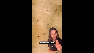 What is Cherry Angiomas [upl. by Alekehs]