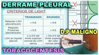 Derrame pleural TORACOCENTESIS DP maligno  Práctica  Casos clínicos  Dra Jauregui [upl. by Aklam912]