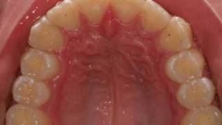 invisalign severe overjet [upl. by Nortal]