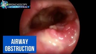 BronchAtlas Describing Central Airway Obstruction [upl. by Jo]