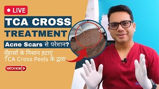 TCA Cross Treatment Live  Remove Acne Scars with TCA Cross Peels  Dr Jangid  SkinQure [upl. by Maryl]