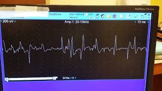 hypoglossal myokymia 3 [upl. by Nalym438]