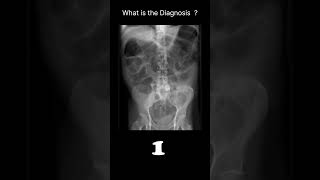 Dilated small amp large bowel Abdominal XrayAbnormalities 69 radiologychannel007 [upl. by Boynton]