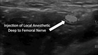 Ultrasound Guided Femoral Nerve Block [upl. by Atiuqehc]