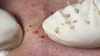 Acne Treatment Huong Da Nang  2024 blackheads 707 [upl. by Sellma]